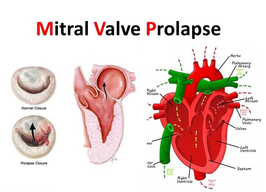 Ayurvedic Treatment ForMitral Valve Prolapse Ayurvedic Treatment For Mitral Valve Prolapse